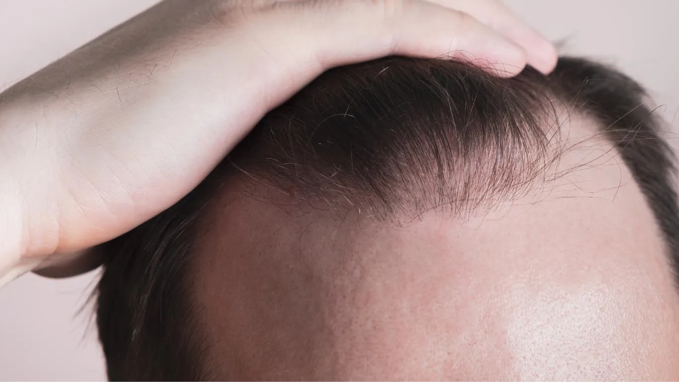 råd efter hårtransplantation göteborg efter hårtransplantaiton