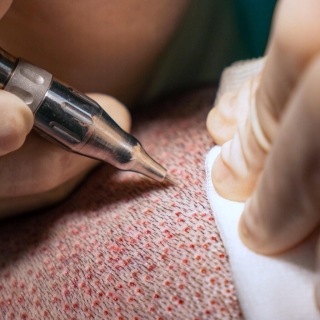 metod för hårtransplantation hårtransplantation göteborg