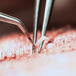 hårtransplantation göteborg metod och teknik hårtransplantation