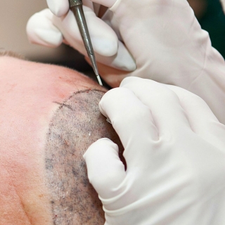 metod för hårtransplantation metoder för hårtransplantation