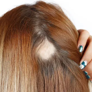 kvinnligt håravfall sjukdom vid kvinnligt håravfall