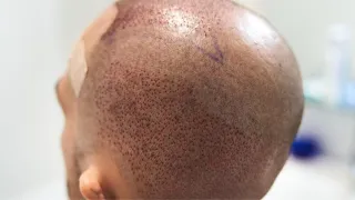 hårtransplantation göteborg råd efter hårtransplantation