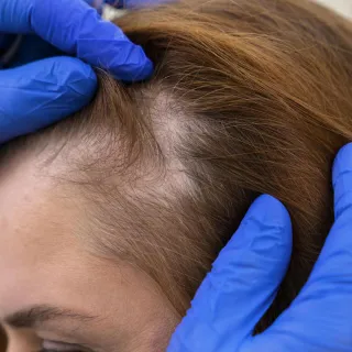 kvinnligt håravfall bakomliggande orsaker till kvinnligt håravfall