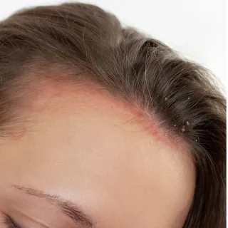 kvinnligt håravfall inflammatoriska tillstånd vid kvinnligt håravfall