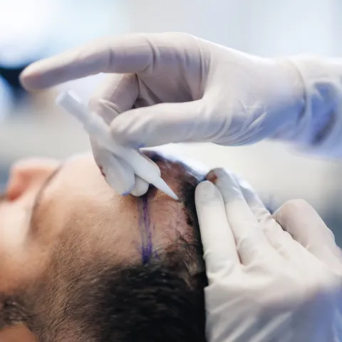 hårtransplantation göteborg metod och teknik hårtransplantation