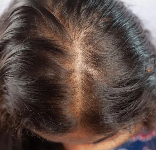 behandling mot håravfall prp som behandling vid håravfall