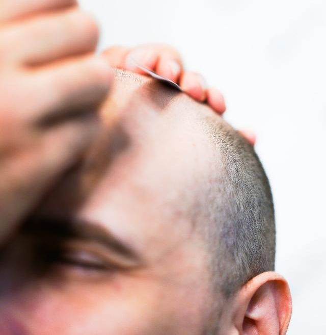 konsultation hårtransplantation konsultation vid hårtransplantation