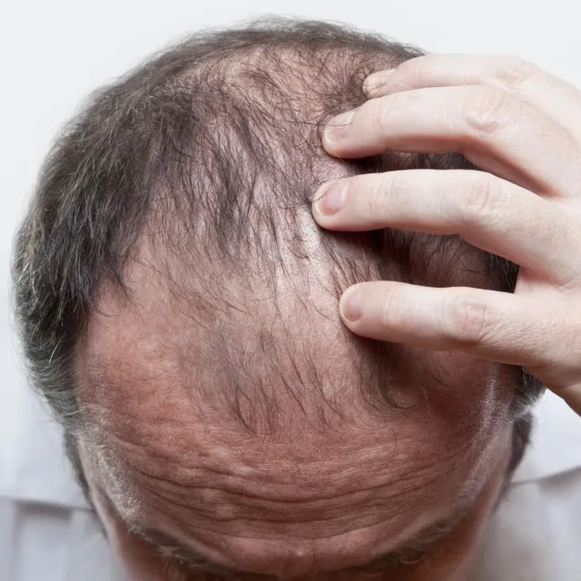 information om håravfall lär dig mer om håravfall