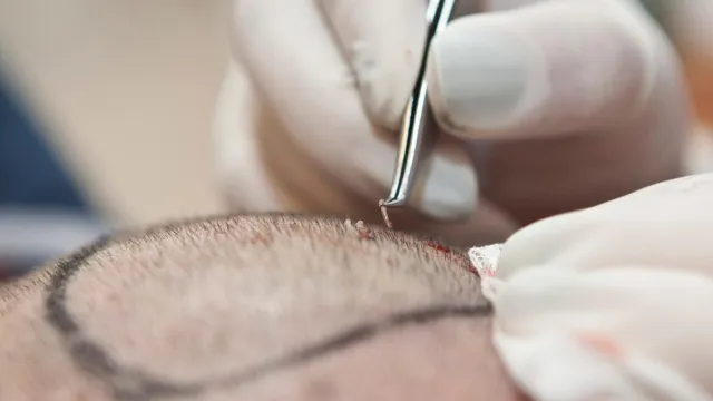 hårtransplantation utförd av läkare hårtransplantation göteborg