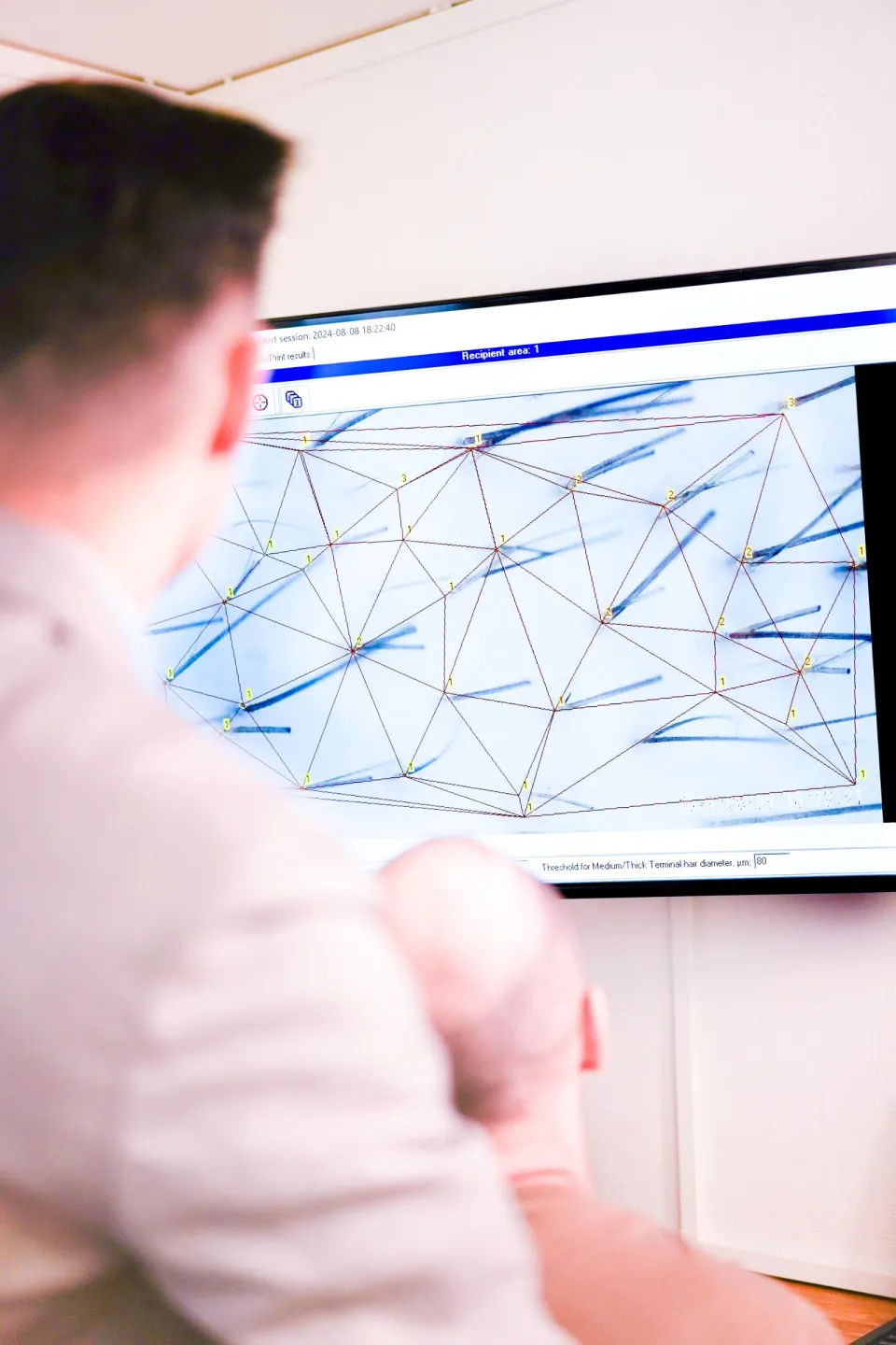 hårtransplantation före och efter hårtransplantation eftervård