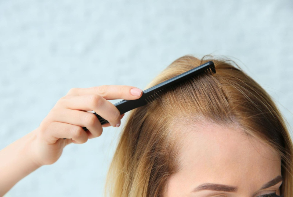 metod för hårtransplantation göteborg hårtransplantation göteborg