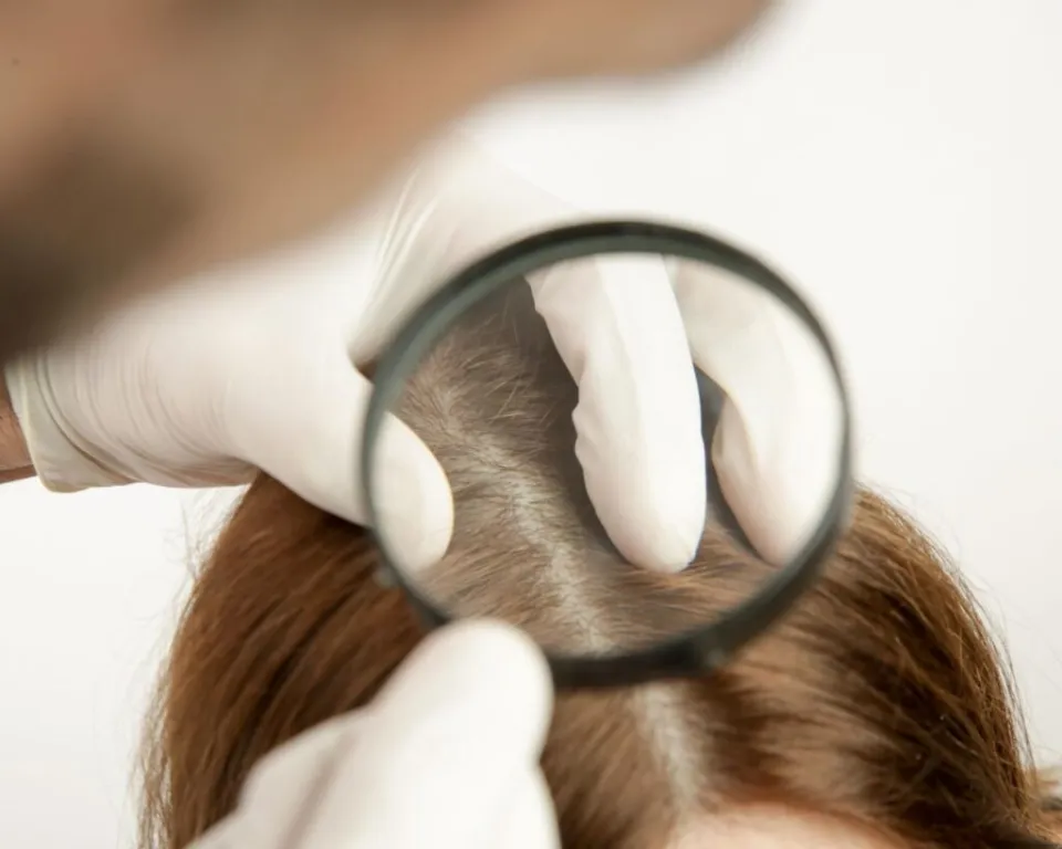 kvinnligt håravfall behandling för kvinnligt håravfall